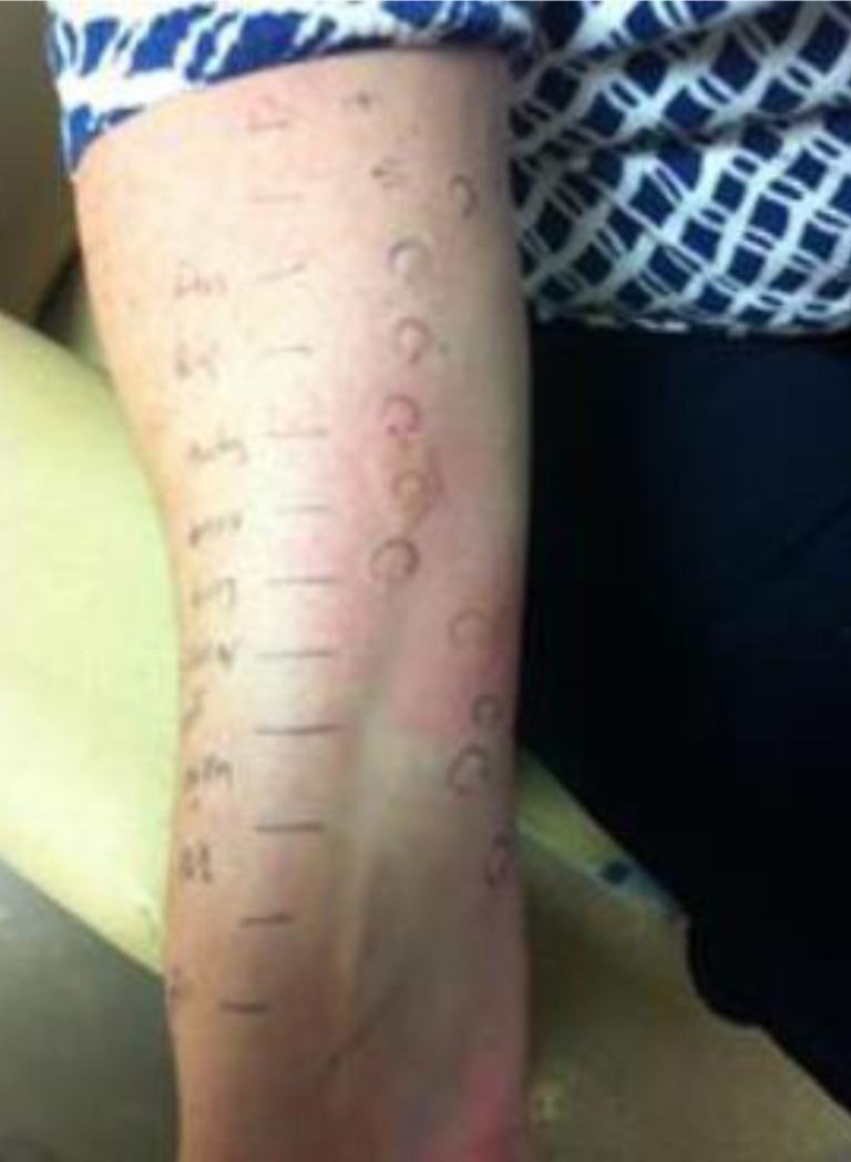 Positive intradermal tests in a patient with penicillin allergy